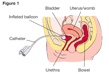 SUPRA-PUBIC CATHETER inserted in a female