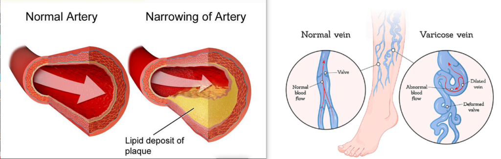 Arterial disease vs venous disease