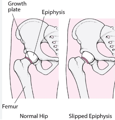 Normal hip vs Slipped capital femoral epiphysis