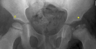 X-Ray left head of femur  Legg-Calve-Perthes