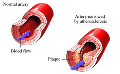 Image show lipid build up in Artery