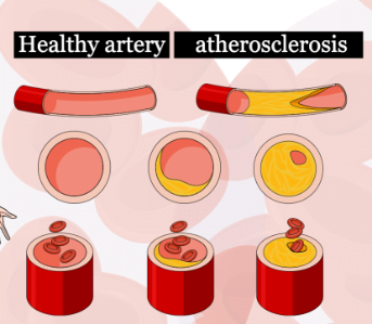 stages in artherosclerosis
