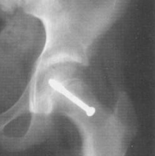 screw holding the bone inplace