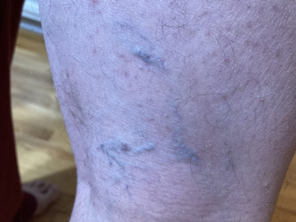 Varicose veins on back of thigh