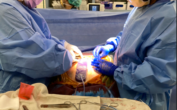 Applying a Prevena Peel and Place Incision Management System after an abdominal surgery.