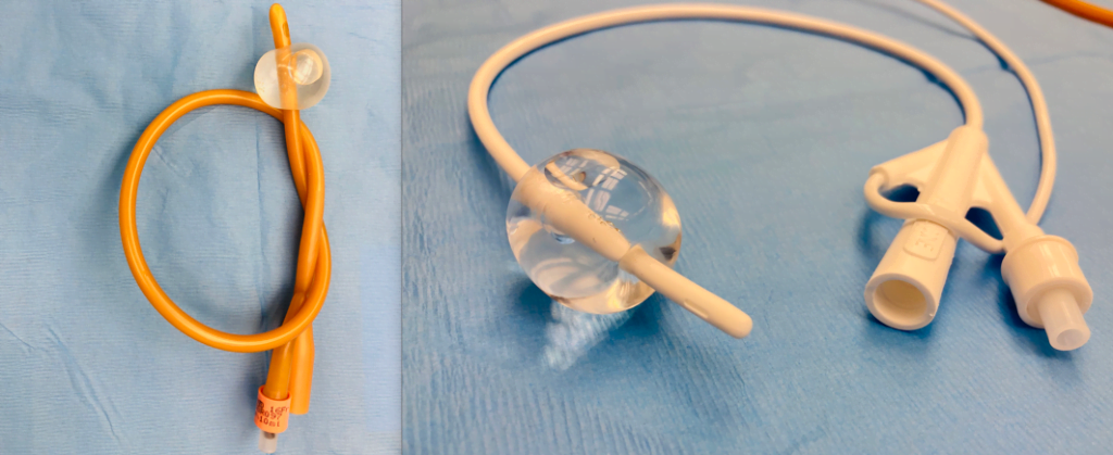 Indwelling foley catheter with balloon inflated