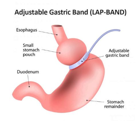 Adjustable Gastric Band showing smaller stomach pouch