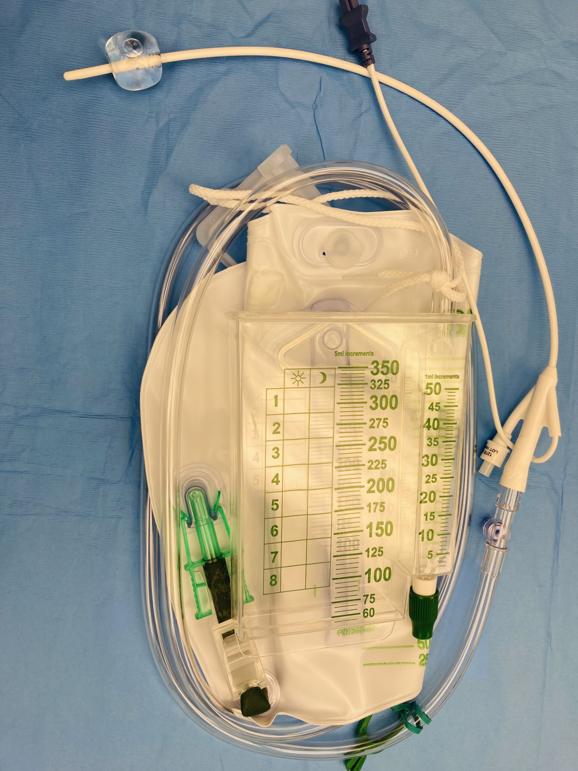 Foley catheter with temperature probe and urine catch bag attached