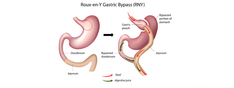 Image of normal digestive organs vs Gastric bypass illustration 